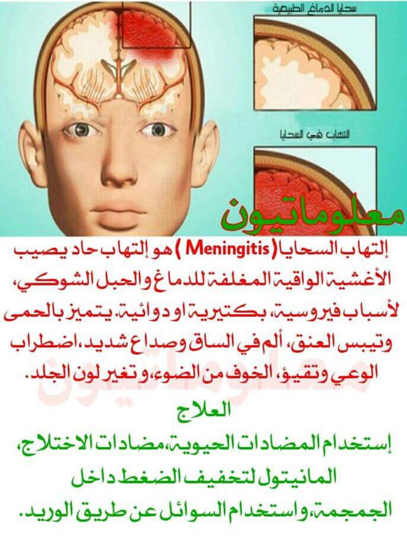 التهاب السحايا Meningitis 93966.fb_img_1498095887792